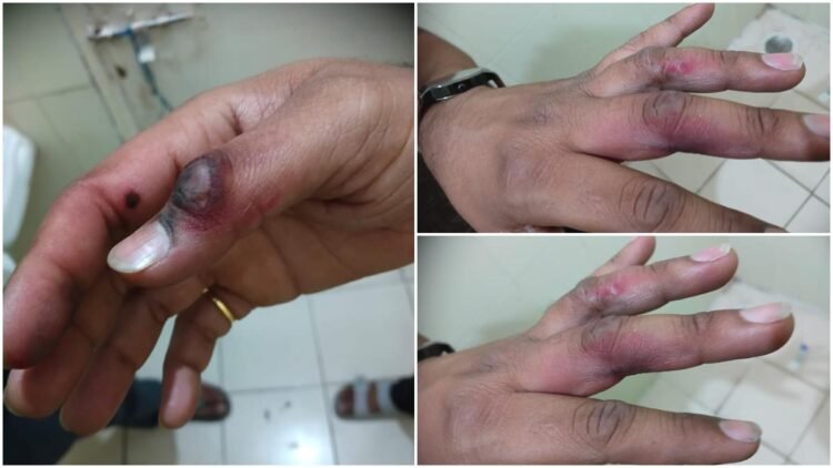 पढ़ाई के बीच अचानक धमाका, मोबाइल फटने से छात्र घायल