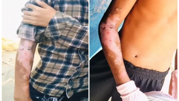 गरियाबंद के आदिवासी छात्रावास में बड़ा हादसा, गर्म दाल गिरने से 2 छात्र झुलसे